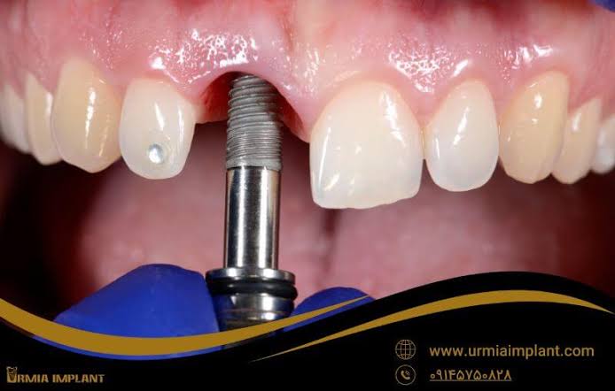 قیمت ایمپلنت تک دندان در ارومیه؛ آیا ارزان بودن همیشه مزیت است؟