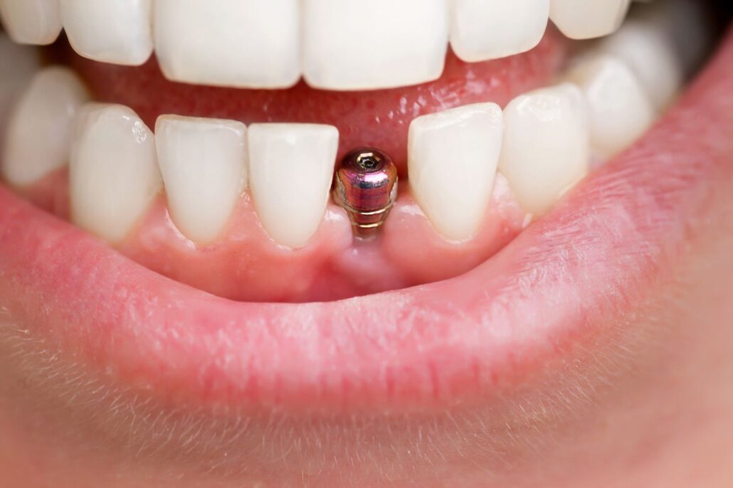 راهنمای جامع و صفر تا صد ایمپلنت دندان جلو 2 picture front tooth implant 3 1030x686 1