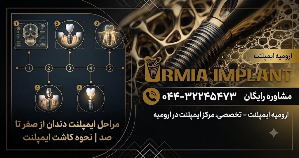 مراحل ایمپلنت دندان از صفر تا صد | نحوه کاشت ایمپلنت